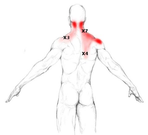 causas de contractura del musculo trapecio causas de contractura del musculo trapecio